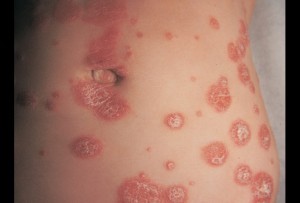 psoriasis-9-9