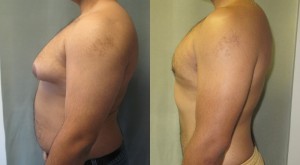 GynecomastiaAsymSevereFL