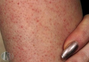 keratosis pilaris